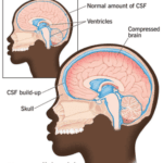 Normal Pressure Hydrocephalus