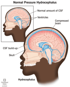 Normal Pressure Hydrocephalus