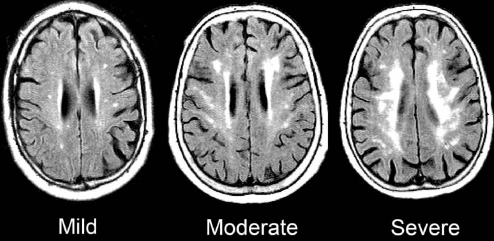 white matter disease mild moderate severe