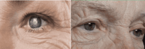 vision changes with dementia