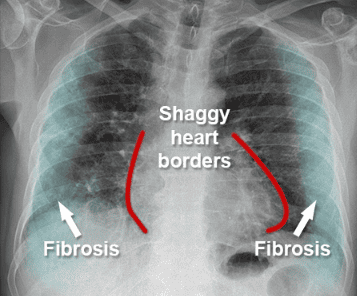 pulmonary fibrosis