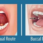 sublingual_vs_buccal