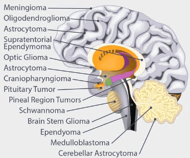 different types of brain cancer