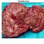 Alcoholic Cirrhosis of the Liver with Ascites